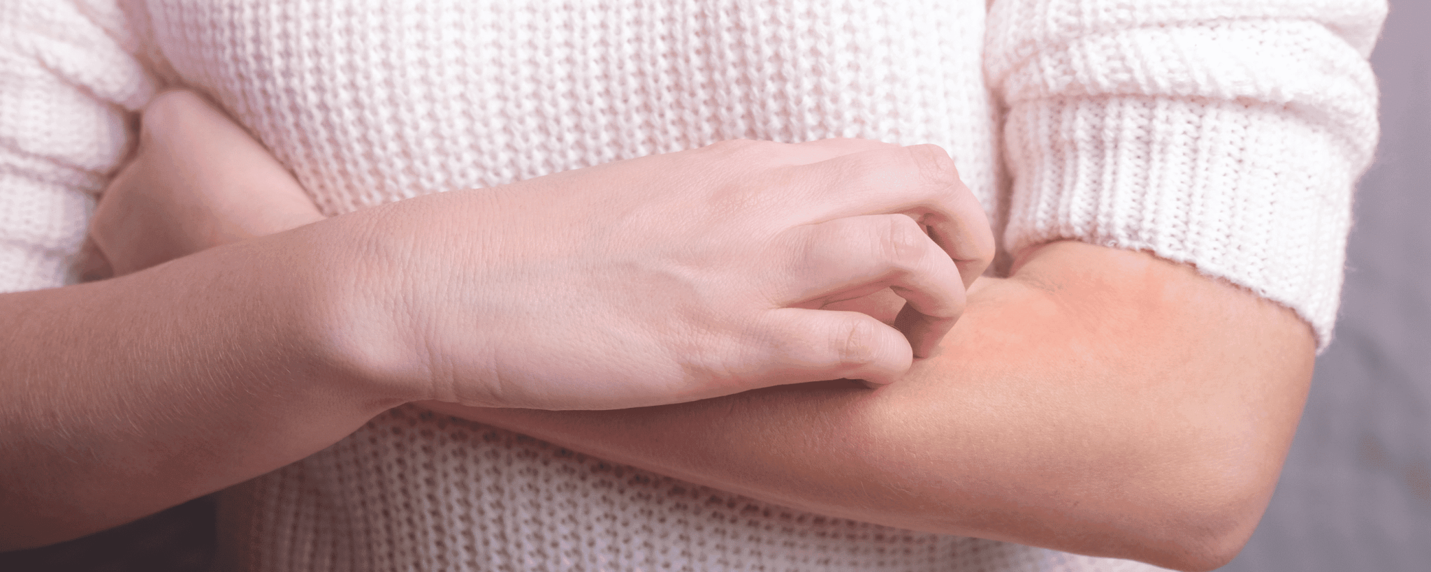 Man sieht die verschränkten Arme einer Frau. Sie kratzt sich mit einer Hand an ihrem Arm, welcher leicht von Neurodermitis betroffen ist.