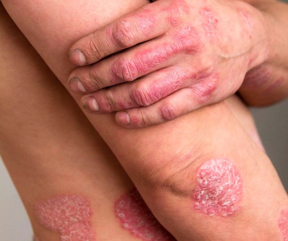 Psoriasis