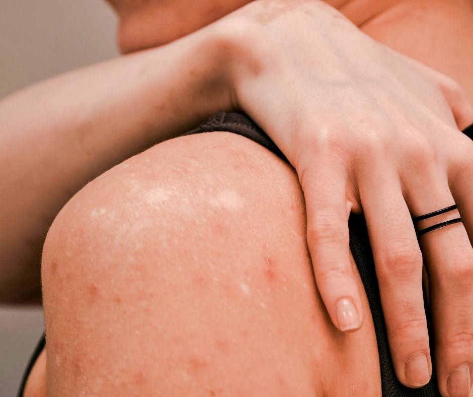 Neurodermitis sanft pflegen | natr Med Care mit NEEMAVERA