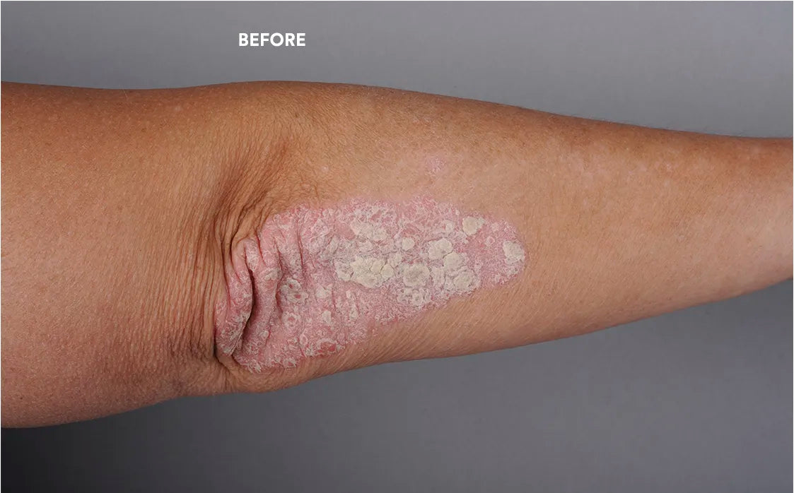 You can see an ellbow of a person that is affected with psoriasis, as it shows white, dry plaques.