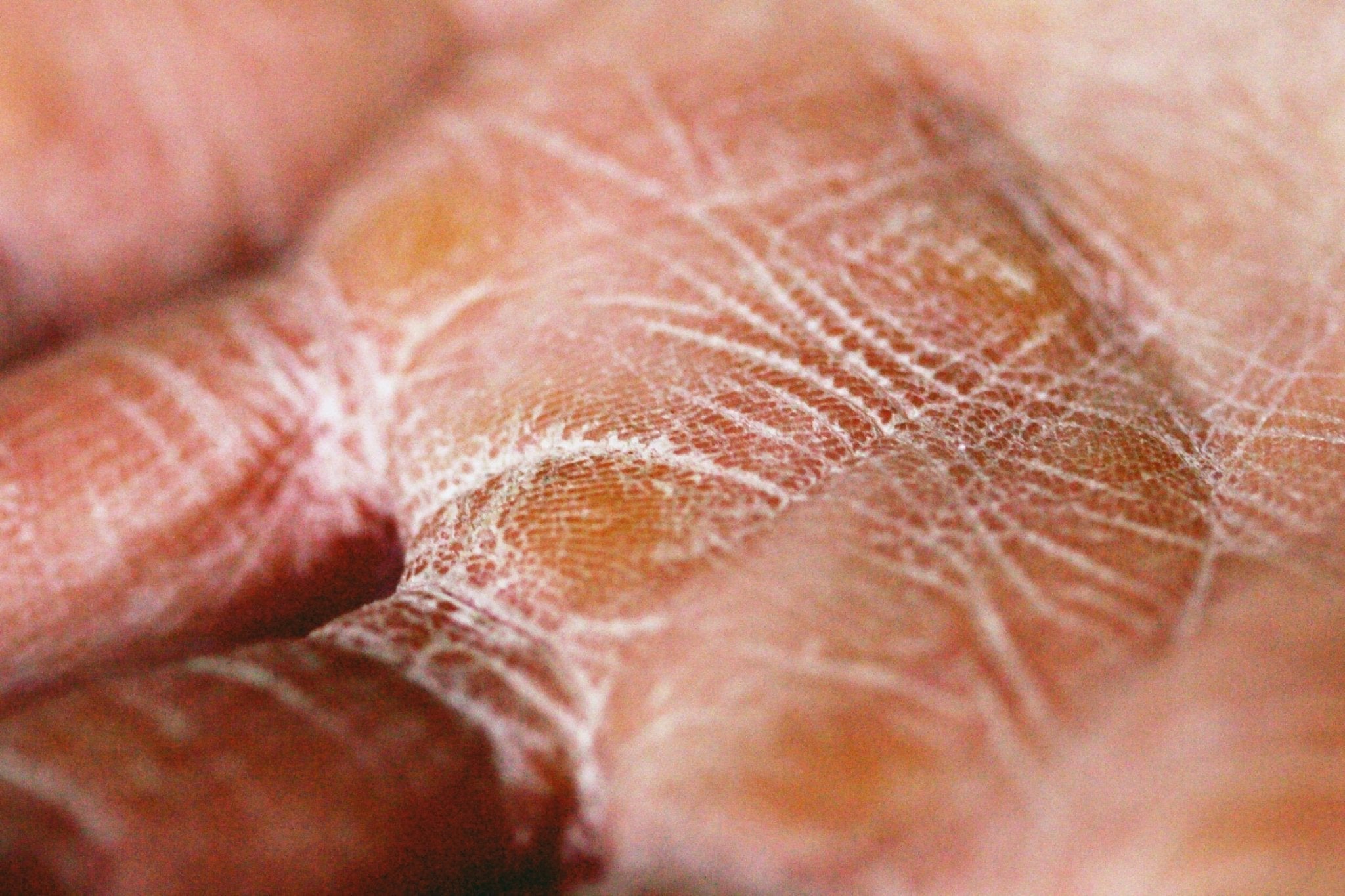 Trockene Haut vs. Dehydrierte Haut: Unterschiede