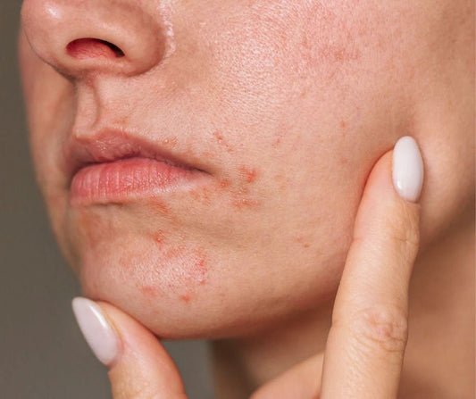 Periorale Dermatitis