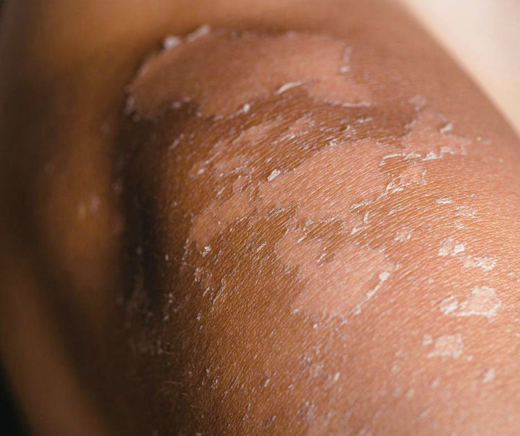 Trockene & sensible Haut