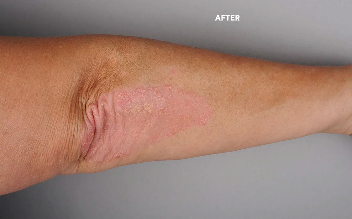 You can see an ellbow after the use of the care cream. The psoriasis affected skin is now smooth and pink.